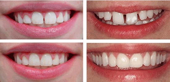 روش های بستن فاصله بین دندان ها