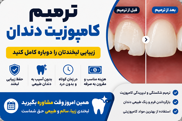 ترمیم کامپوزیت دندان