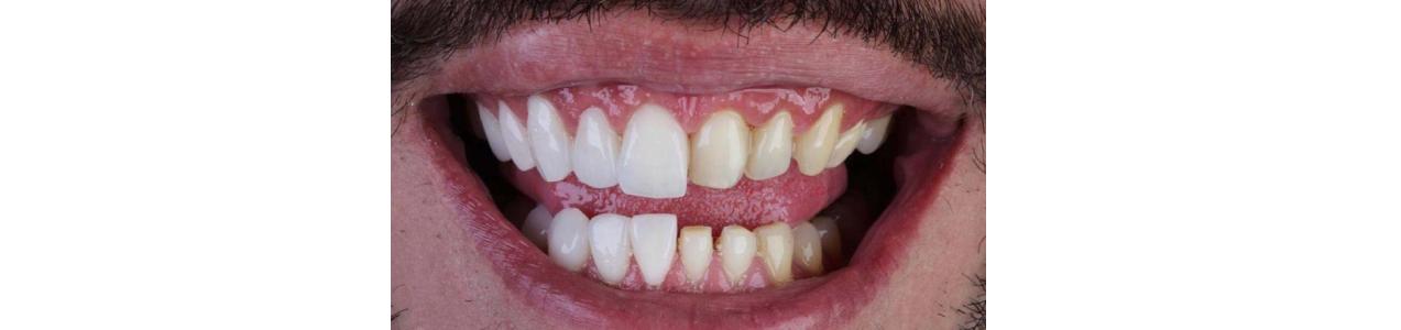 لمینت بدون تراش