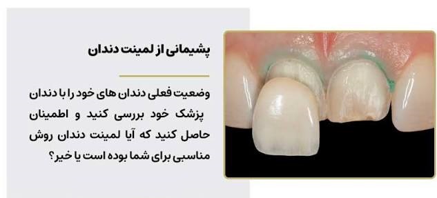 پشیمانی بعد از لمینت دندان