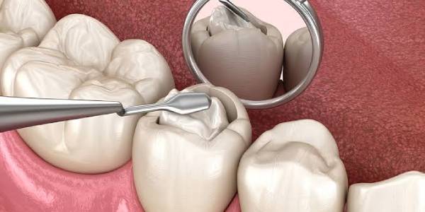 افراد مناسب برای کامپوزیت دندان