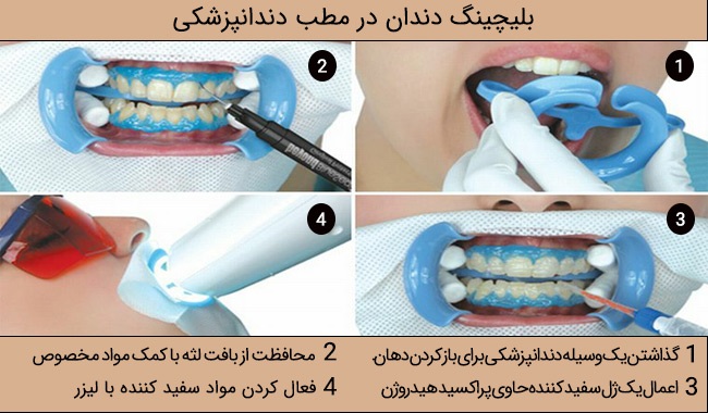 مراحل بلیچینگ دندان