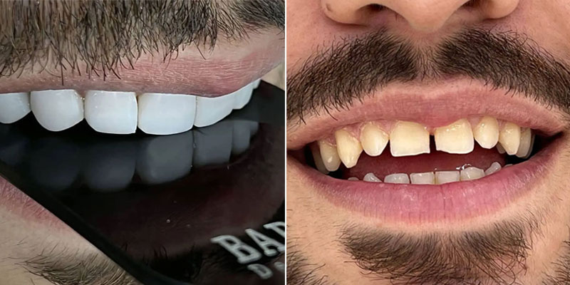 نمونه درمان کامپوزیت دندان خرگوشی