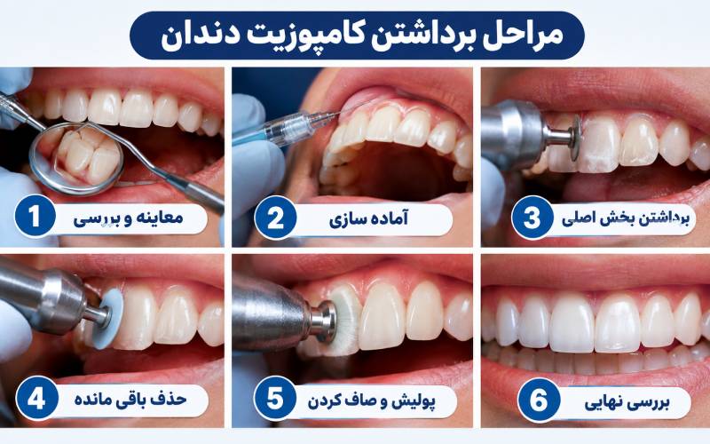 مراحل برداشتن کامپوزیت دندان