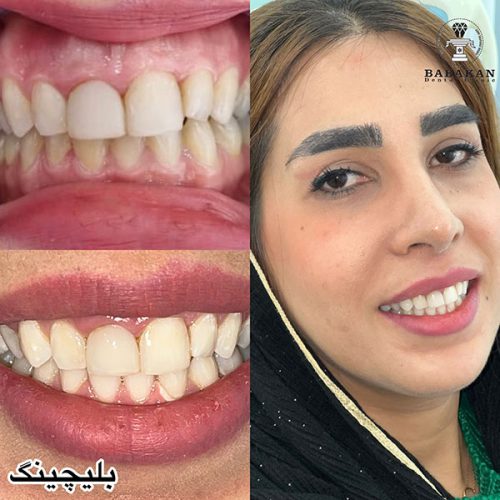 نمونه درمان بلیچینگ دندان خانوم