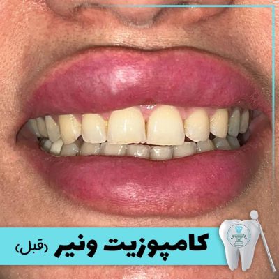 نمونه درمان کامپوزیت دندان بابکان