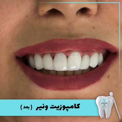 نمونه درمان کامپوزیت دندان بابکان