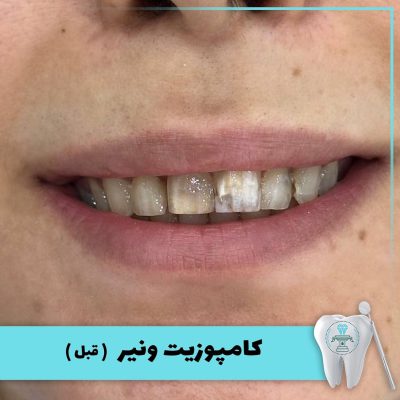 نمونه درمان کامپوزیت دندان بابکان