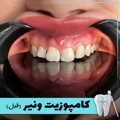 نمونه درمان کامپوزیت دندان بابکان