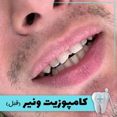 نمونه درمان کامپوزیت دندان بابکان