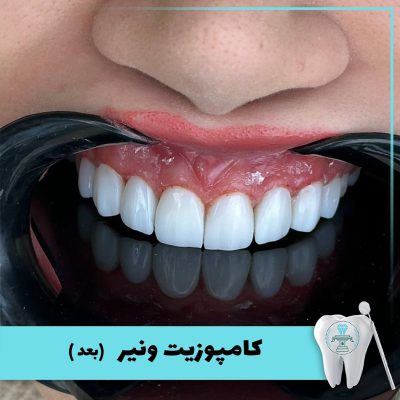 نمونه درمان کامپوزیت دندان بابکان