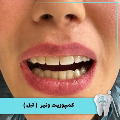 نمونه درمان کامپوزیت دندان بابکان