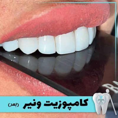 نمونه درمان کامپوزیت دندان بابکان